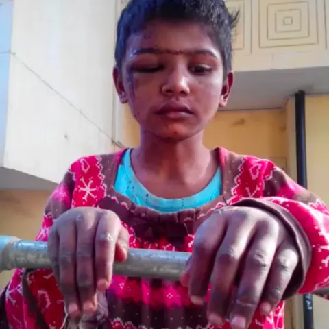Tayyabas hands were burned and the scars remain today